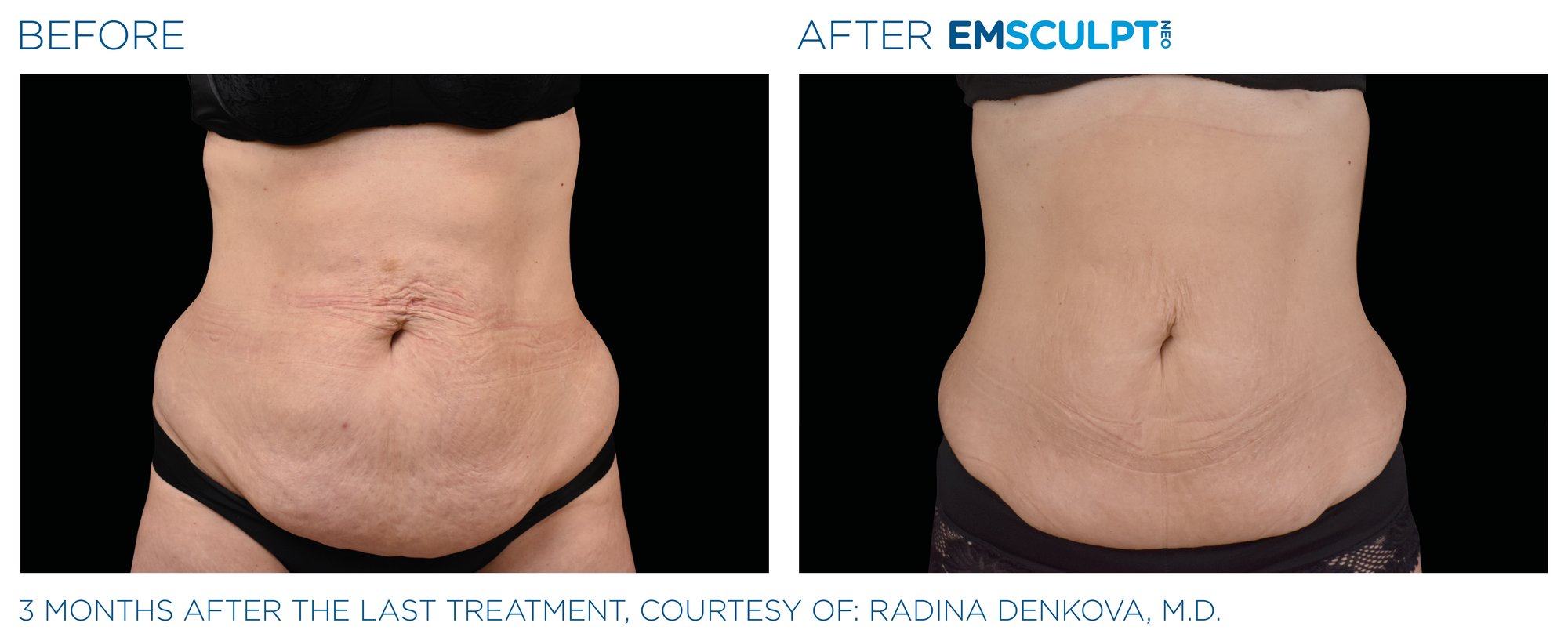 Emsculpt_neo_PIC_Ba-card-female-abdomen-009_ENUS100 Emsculpt_neo_PIC_Ba-card-female-abdomen-009_ENUS100