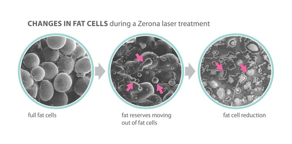zerona-fat-cells